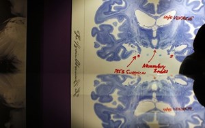 Hình ảnh quét não của một người phụ nữ 
